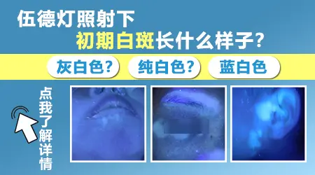 确诊是不是白癜风做哪些检查好