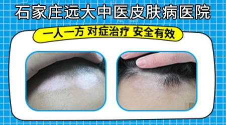 白癜风边缘更清晰了怎么回事