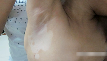 男性腋窝里有一片白色皮肤是怎么了