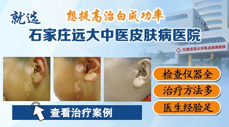 石家庄哪个医院检查白斑好