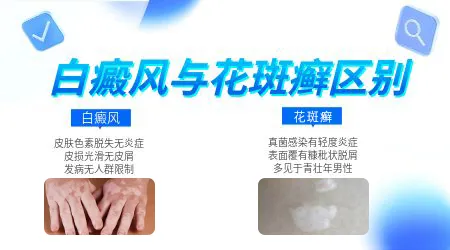 如何区分白癜风与汗斑