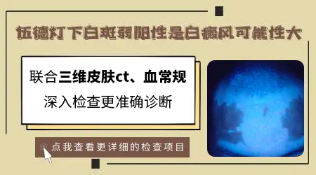 伍德灯检查白斑弱阳性是不是白癜风