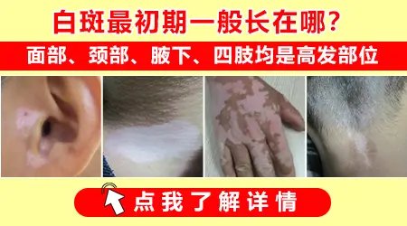 腋窝下有白色斑怎么回事