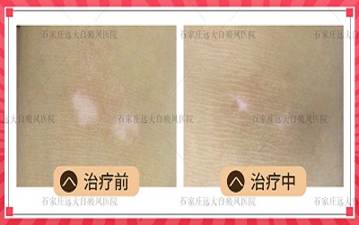 照完308激光白癜风患处微微红正常吗