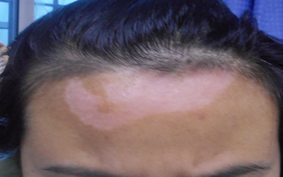 额头和发际线之间的皮肤发白怎么治