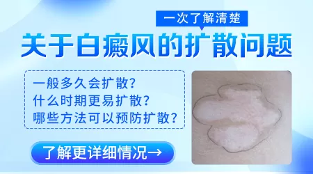 白癜风一般多久扩散