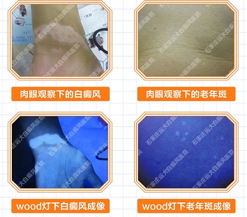 老人身上长白点是怎么回事