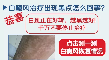 白斑上出现黑点怎么回事