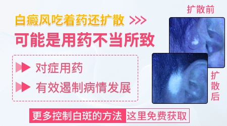 白癜风边治疗边蔓延到其他部位怎么办