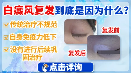 有没有能根治白癜风的方法