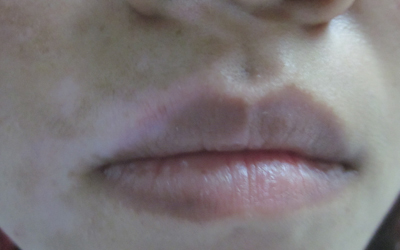 口唇白斑初期症状图片