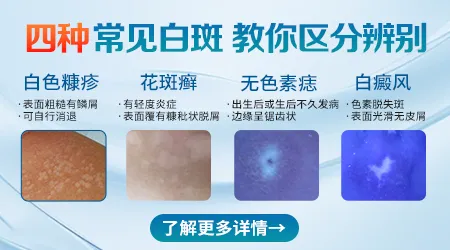 如何区分白癜风与汗斑