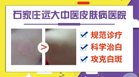 白癜风治疗后还出现新的白斑