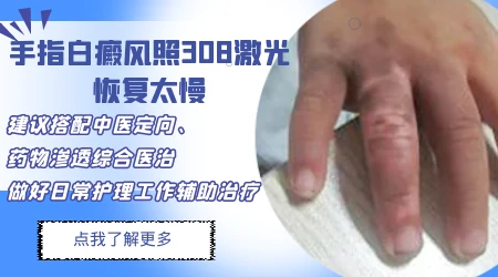 什么类型的白癜风照激光比较有效