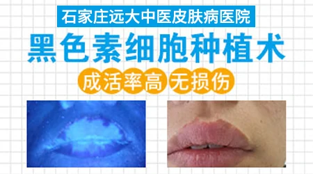黑色素细胞种植治白斑多少钱