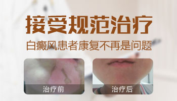 他克莫司治疗白癜风效果好不好