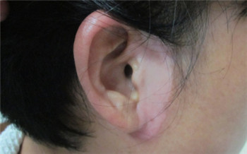 耳朵前面长了两片白斑是什么病