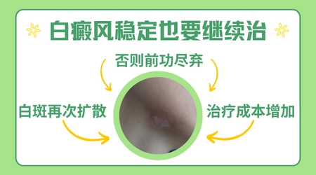 石家庄308激光治疗白癜风医院哪家强