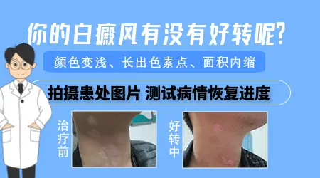白癜风恢复过程