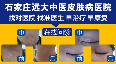 石家庄治皮肤白斑专家排行榜