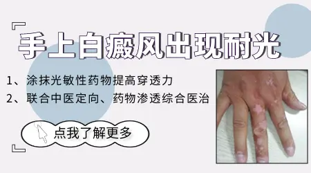 白癜风照308出现耐光性需要暂停多久