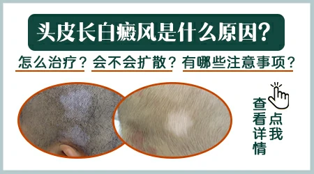 孩子头皮上一小块白斑照光能好吗