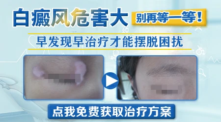 炎症后白斑会扩散吗