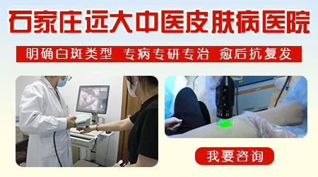 预防白癜风复发的方法