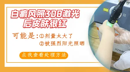 脸上长白癜风照光后很红怎么办