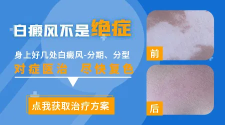 宝宝脸上白癜风早期症状图片