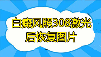 小孩手上白癜风照308照好的案例