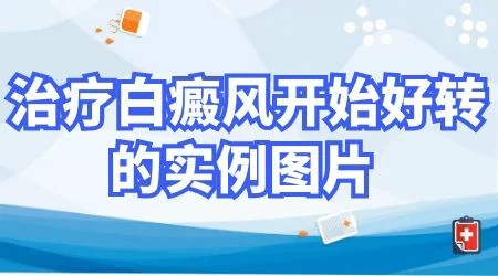 白癜风治疗要多久 白癜风有哪些变化说明在好转