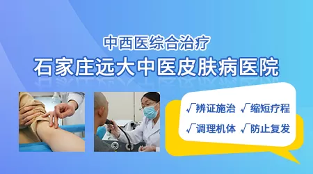肛周有白癜风怎么治