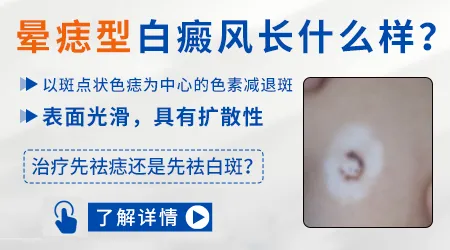 晕痣型白癜风会不会扩散