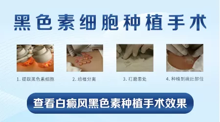 黑色素种植治疗白癜风哪家医院好
