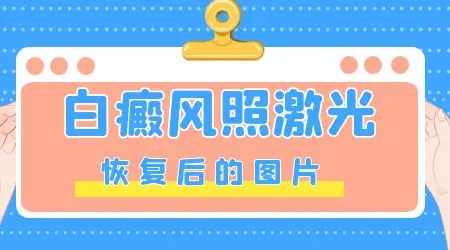 祛白酊可以用于脸部白癜风吗