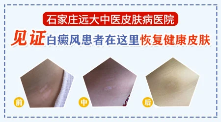 石家庄哪家医院中西医结合治白癜风