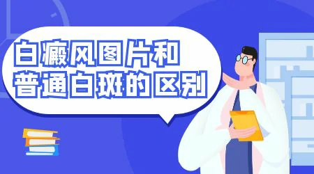 白斑和白癜风图片对比