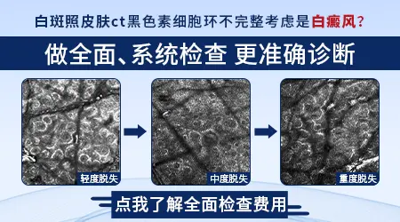 皮肤ct检查白斑多少钱一次
