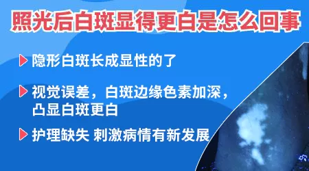 308治疗手指白癜风越照越白什么原因