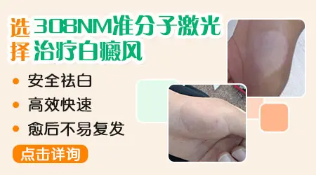 晕痣可以直接照光吗