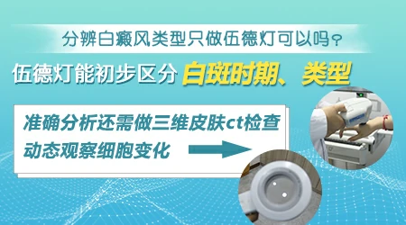 肛周白癜风抹哪种药