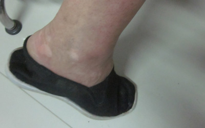 脚上长白斑是什么原因引起的