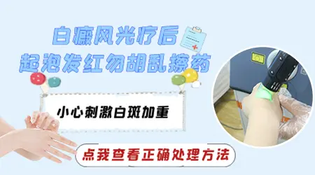白癜风照光后起泡疹应如何处理
