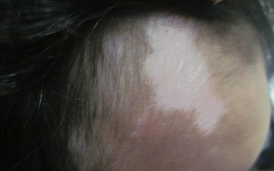 头部和颈部硬币大小的白斑是什么