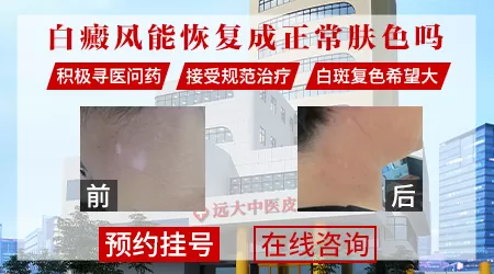 得了白癜风可以恢复正常颜色