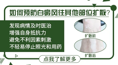 白癜风扩散的征兆是什么