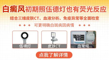 伍德灯能否检测早期或不典型的白癜风