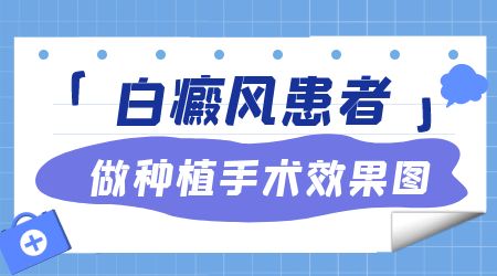 白癜风做黑色素细胞手术几天后可以出院