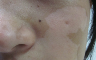 左脸上的白斑扩散了有三个月了怎么治